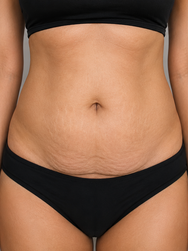 Abdominoplastie poze